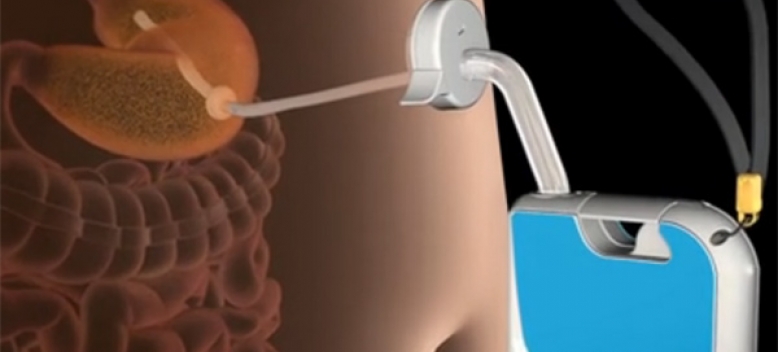 aspireassistaspirationtherapysystem